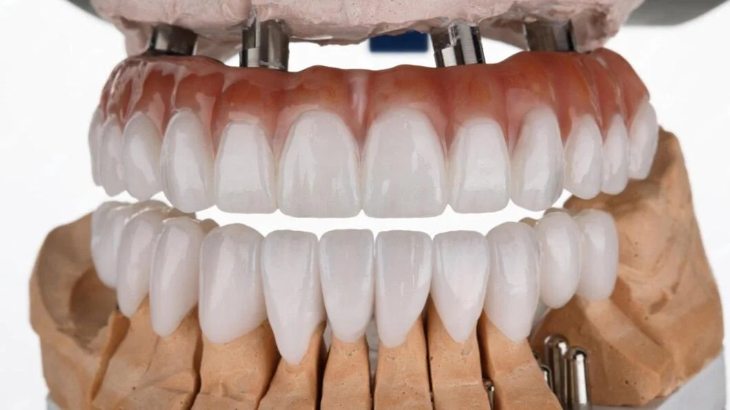 Multilayer Zirconia Crowns & Bridges