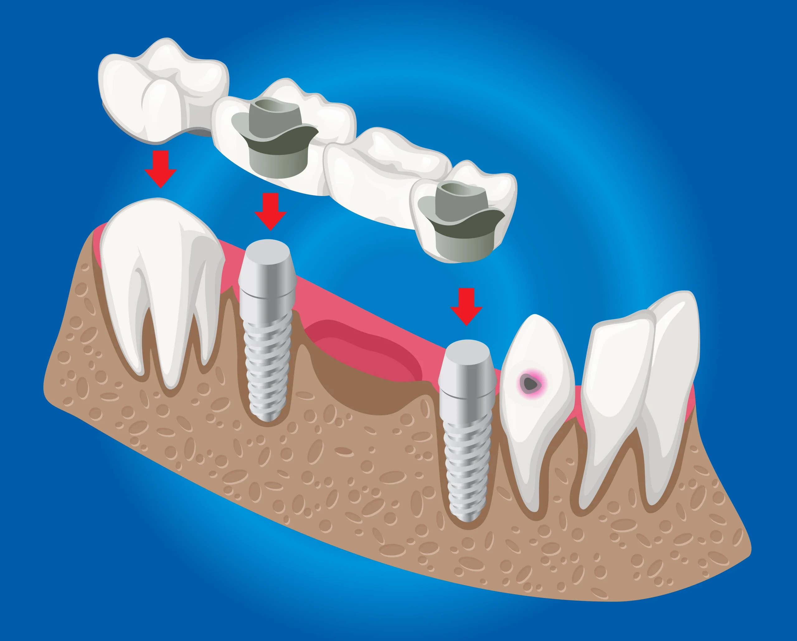 Implant abutment dental restoration