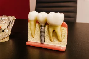 Implant Restoration