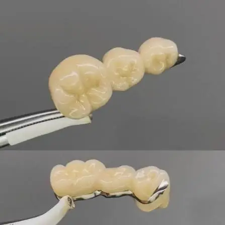 Lingual Collar Metal Crowns