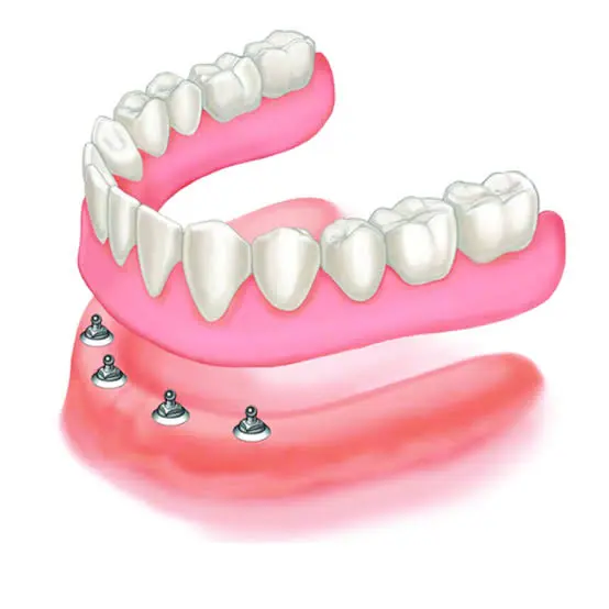 Removable