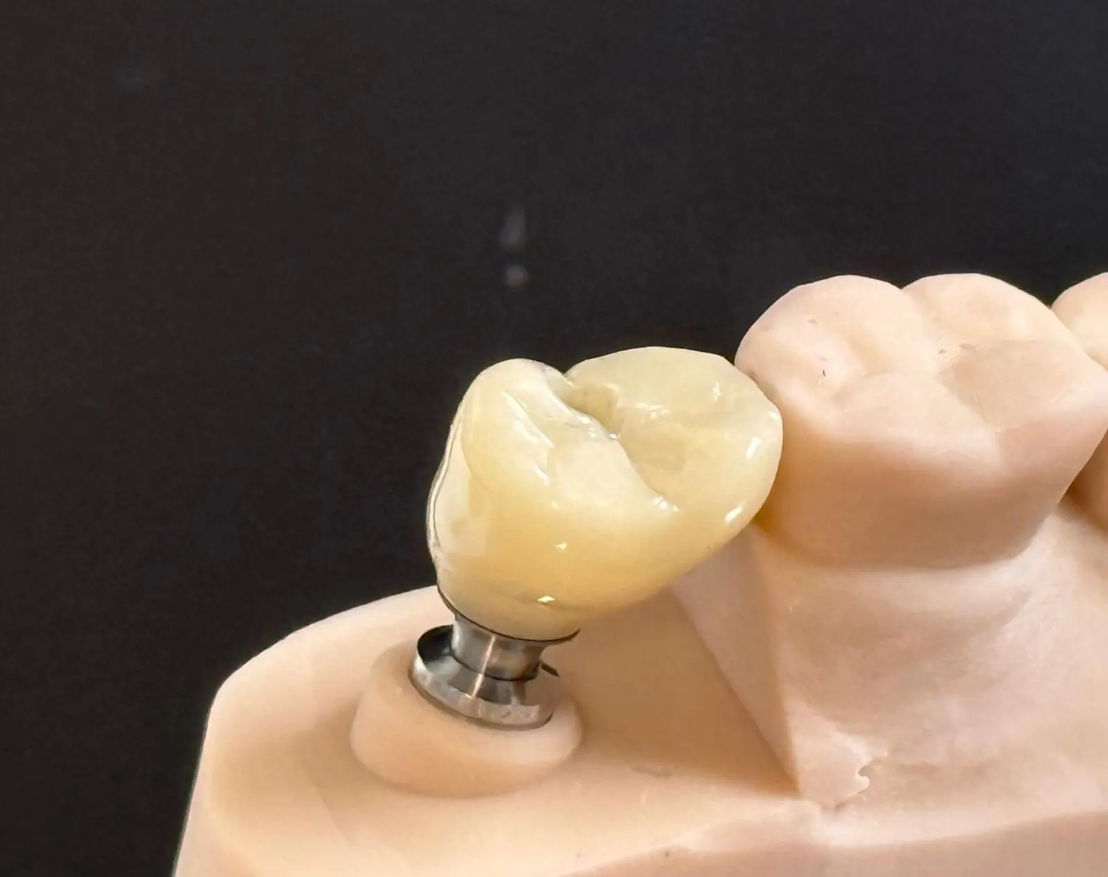 Screw-retained implant crowns